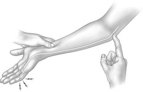 Special test for the neurological dysfunction of the elbow joint: