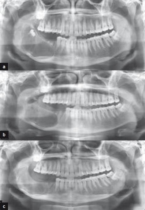 Ameloblastoma Radiograph