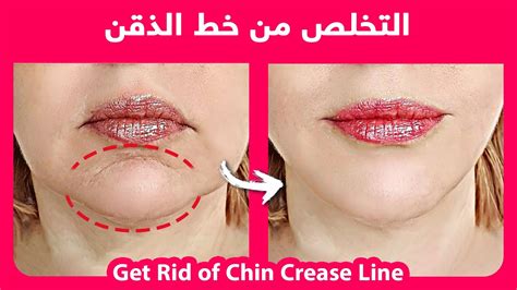 How To Naturally Get Rid Of The Chin Crease Line Mental Crease