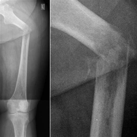 Radiographs Of The Left Femur Showing A Pathological Fracture