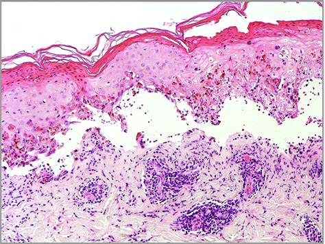 U K Guidelines For The Management Of StevensJohnson Syndrome Toxic