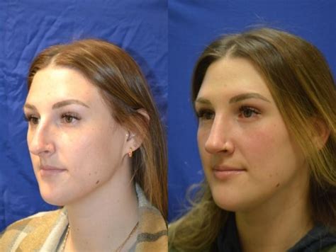 Nose Surgery Before And After Photos Patient 304 San Francisco Ca Kaiser Permanente Cosmetic