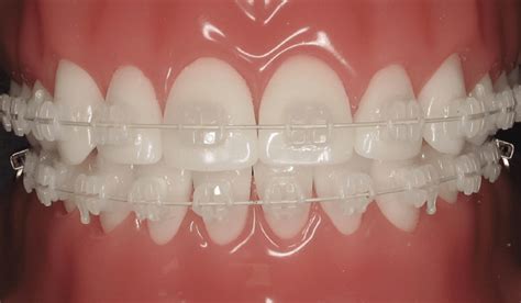 Invisible Braces Cost Senior Braces Dentist In Hyderabad India