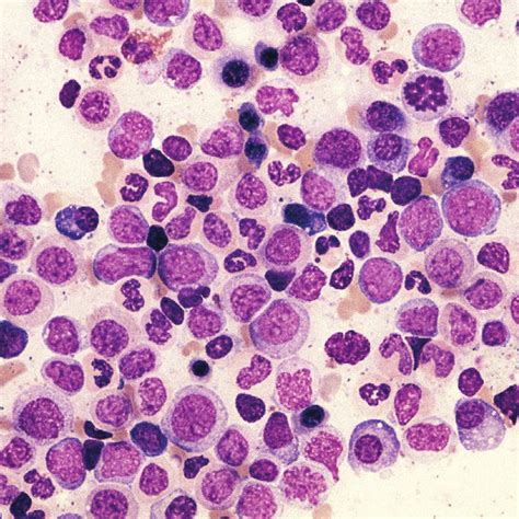 The Bone Marrow Aspirate Smear Shows Myeloid Hyperplasia And Immature