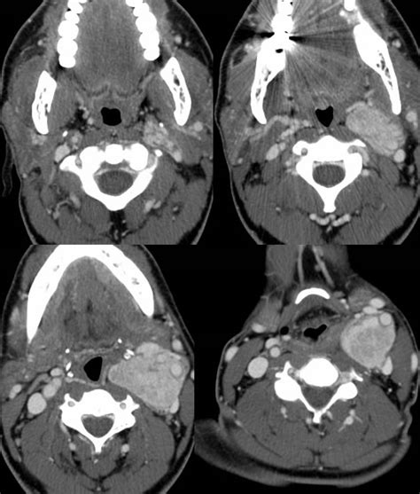 Paraganglioma