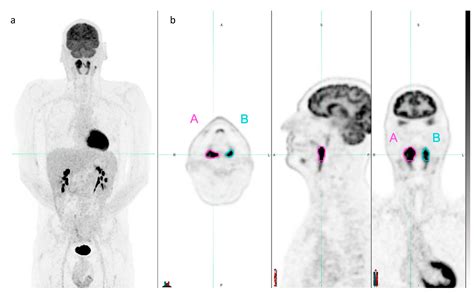 Diagnostics Free Full Text Baseline F Fdg Pet Ct Radiomics In