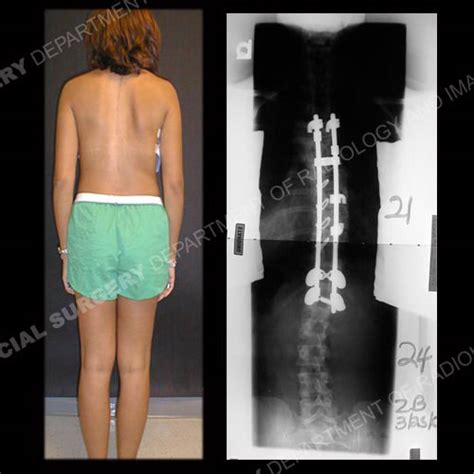 Scoliosis In Adults What To Know About Symptoms And Treatment
