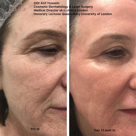 Fully Ablative CO2 Laser Resurfacing Treatment Dr H Consult