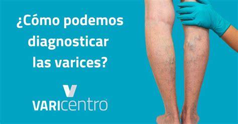 C Mo Podemos Diagnosticar Las Varices Varicentro Tratamiento De