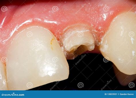 Fractured tooth stock image. Image of discolored, teeth - 13823931