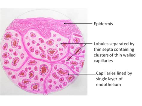 Capillary Hemangioma - Pathology Made Simple