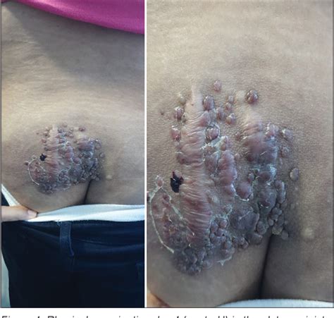 Figure From Nevus Lipomatosus Cutaneous Superficialis With A