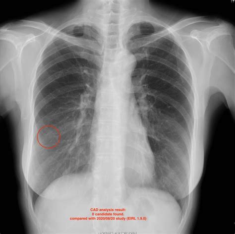 Eirl Chest Nodule Eirlエイル Ai画像診断支援技術 エルピクセル株式会社