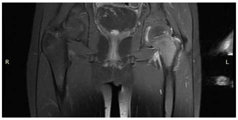 Jcm Free Full Text Osteoid Osteoma A Diagnostic Problem A Series Of Atypical And Mimicking