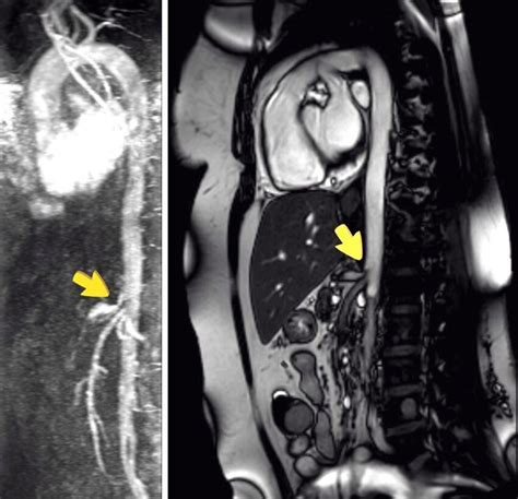 (a) Severe stenosis and poststenotic dilatation of the celiac artery in... | Download Scientific ...