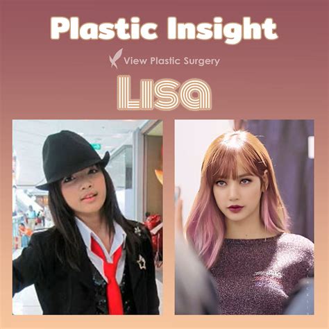 Lisa Plastic Insight Nowadays Kpop Is At The Peak Of By View