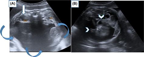 A B Antenatal Ultrasound Images Show Heterogeneously Echogenic Download Scientific Diagram