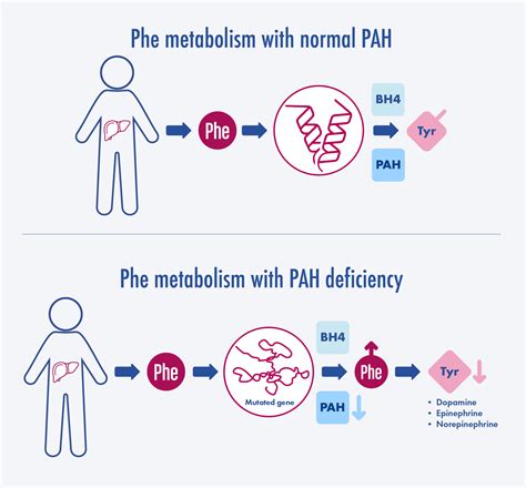 Genetics And Pathophysiology Of Phenylketonuria Pku