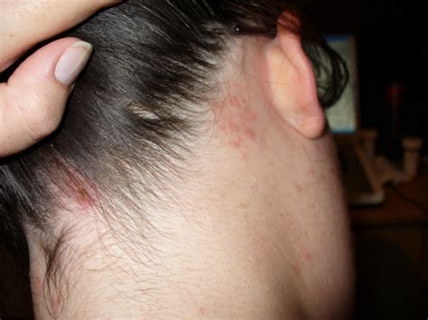 12 Effective Ways To Manage Scalp Infection At Home Diy Find Home