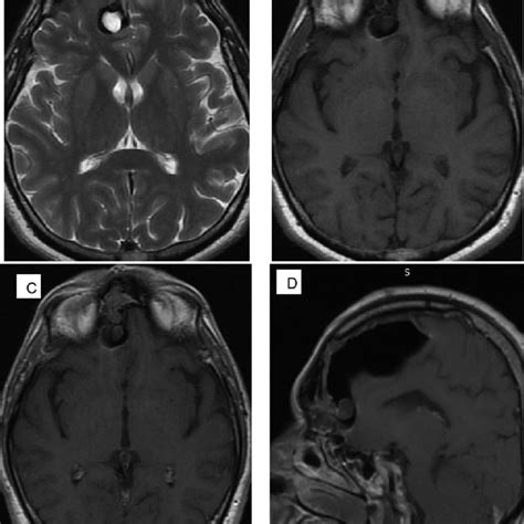 Case A T2 Weighted Images In Axial Plane B C Axial And Sagittal