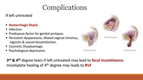 Rectovaginal Fistula And Perineal Tear Ppt