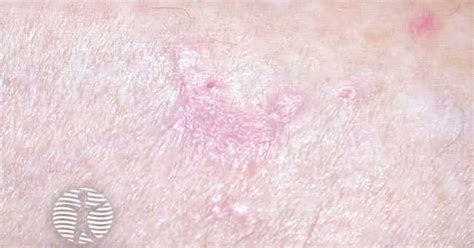 Dermnet Lichen Planus Image