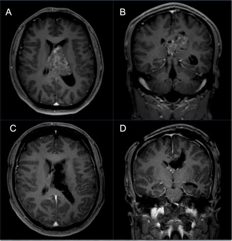 A 32 Year Old Male Patient Presented With Severe Headache Diplopia