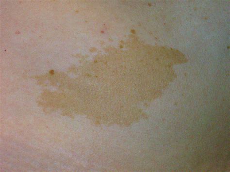 Birthmarks Types Causes And How To Care For Them