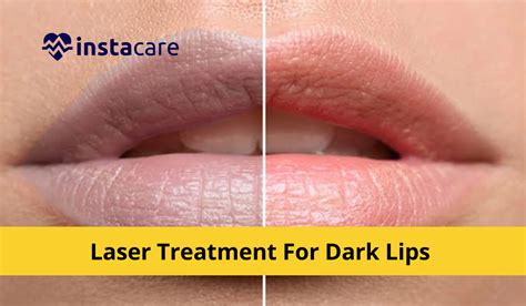 How To Lighten Dark Dark Lips Are Distressing For Many