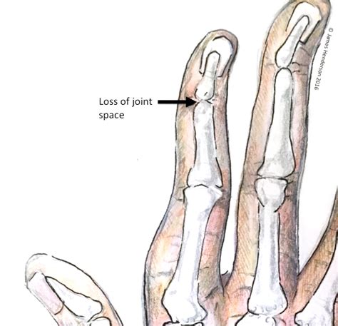 Finger Joint Arthritis - James Henderson - Specialist Plastic & Hand Surgeon