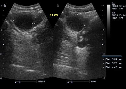 Hemorrhagic Ovarian Cyst Radiology Case Radiopaedia Org