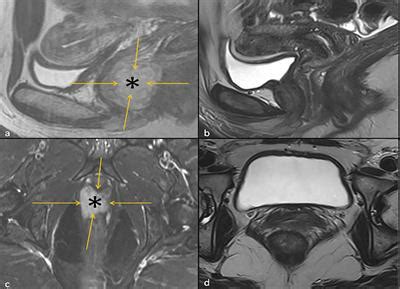 Frontiers Case Report Durable Complete Pathologic Response And Organ