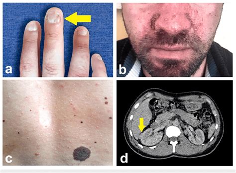 Different manifestations of tuberous sclerosis complex in this case.... | Download Scientific ...