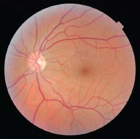 Example Of Non Mydriatic Digital Fundus Photograph Showing Mild