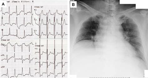 A Electrocardiograph Showed Sinus Tachycardia And Left Ventricular