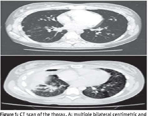 Figure 1 From Role Of FDG PET Scan In Staging Of Pulmonary Epithelioid