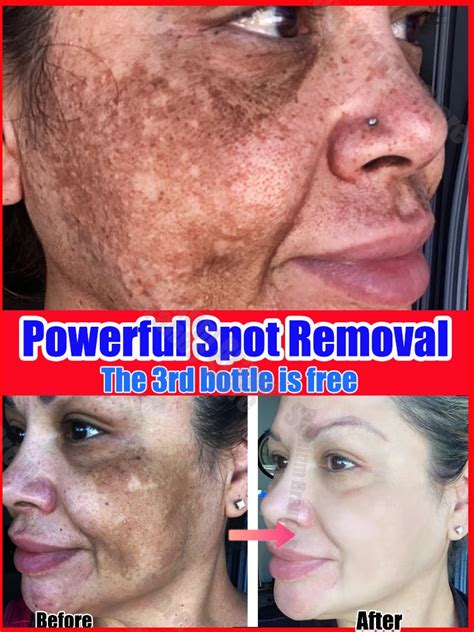 Dark Spot Remover Melasma Chloasma Black Spots Cream