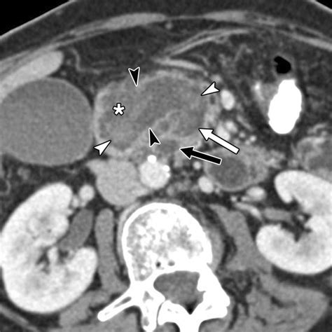 Invasive Intraductal Papillary Mucinous Neoplasms CT Features Of