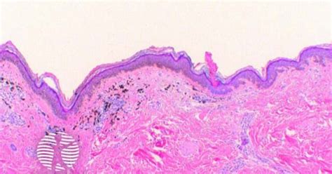 Pigmented Porokeratosis Histology Image