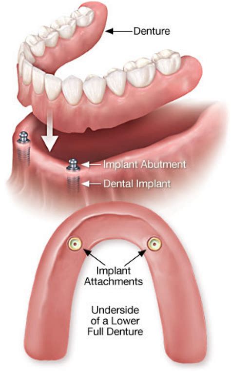 Precision Dental And Dentures Of Jay Oklahoma