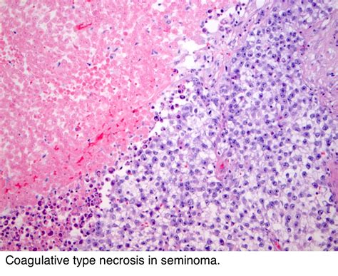 Pathology Outlines Seminoma