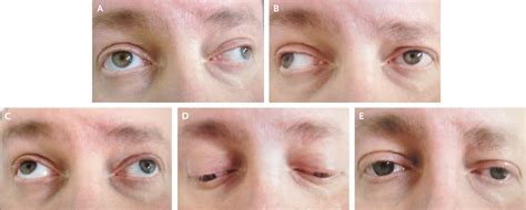 Ophthalmoplegia; Oculomotor Paralysis