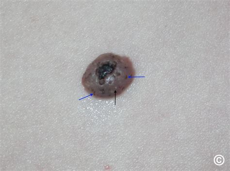 Seborrheic Keratosis Vs Melanoma