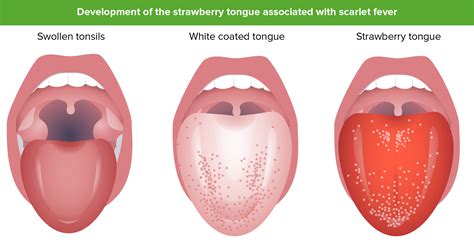 Strep Throat Rash Scarlet Fever