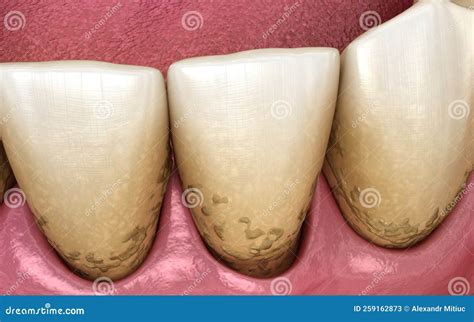 Tartar And Bactrail Tooth Plaque Lower Jaw Medically Accurate D