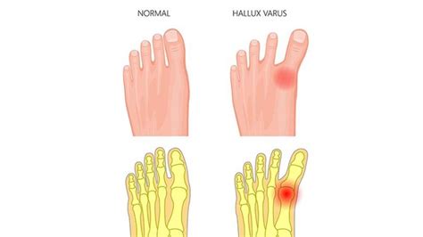 Qu Es El Hallux Varus S Ntomas Causas Y C Mo Tratar La Enfermedad