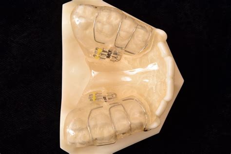 Removable Palate Expanders Parklund Orthodontic Lab