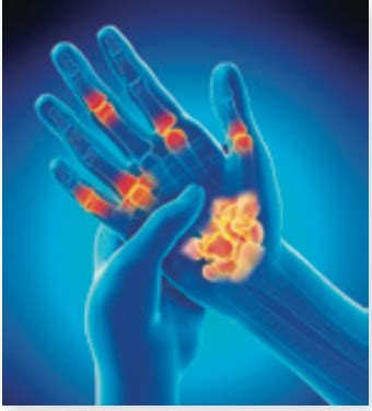 Surgery For Rheumatoid Arthritis Arthritis Advisor