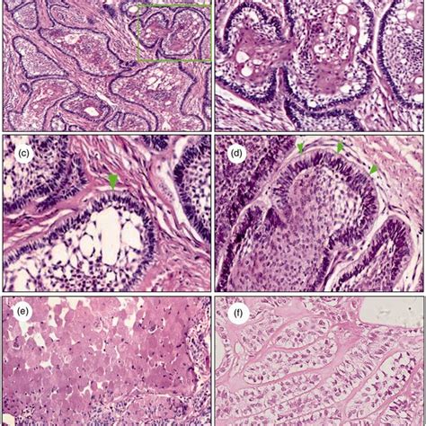 Hematoxylin And Eosin Staining Of Tumor Samples From Both Cases A