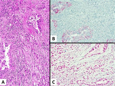 A Case Of Sarcomatoid Pleomorphic Carcinoma Of The Lung A